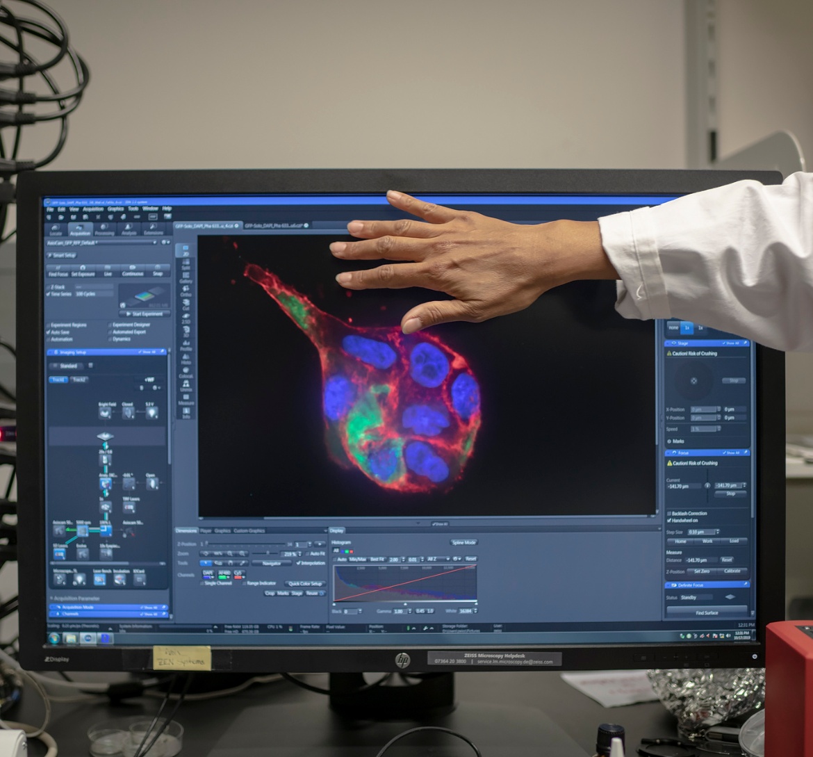 Eine Simulation von Brustkrebszellen auf einem Computerbildschirm.