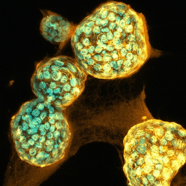 Tumor cells viewed through a microscope