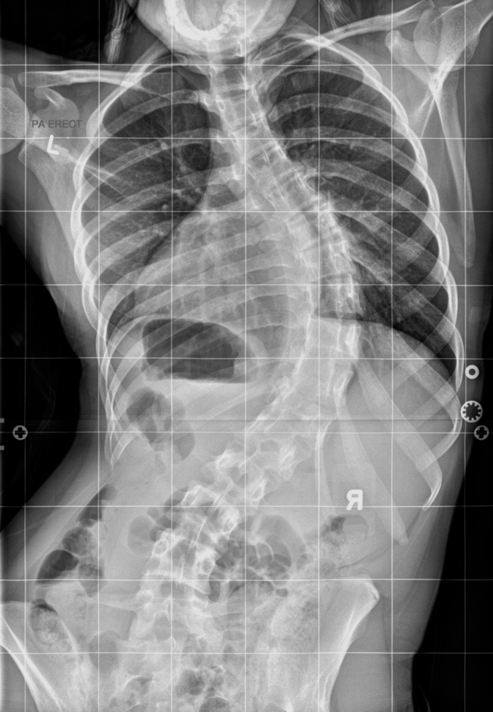 X-ray image of a spinal curvature. 