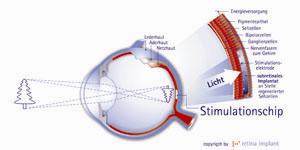 Retina-Implant-Chip