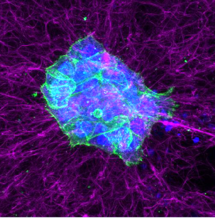 Cluster von Hautkrebszellen, die auf einem fluoreszenzmarkierten Kollagennetz wandern.